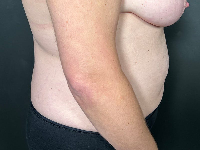 Abdomen Before & After Gallery - Patient 924975 - Image 5