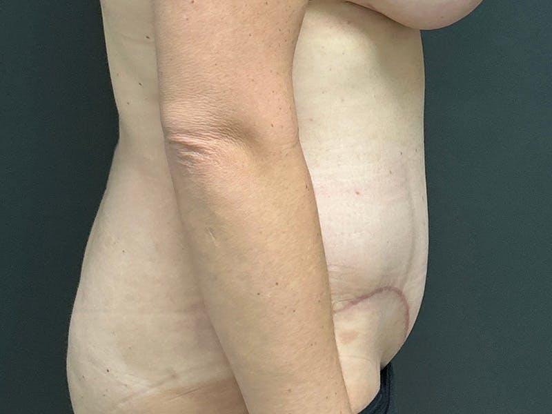 Abdomen Before & After Gallery - Patient 924975 - Image 6