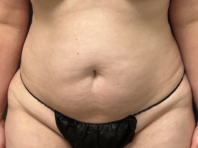 Abdomen Before & After Gallery - Patient 272999 - Image 1