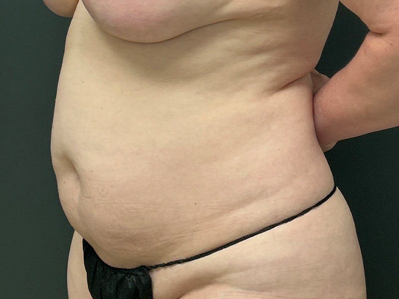 Abdomen Before & After Gallery - Patient 272999 - Image 3