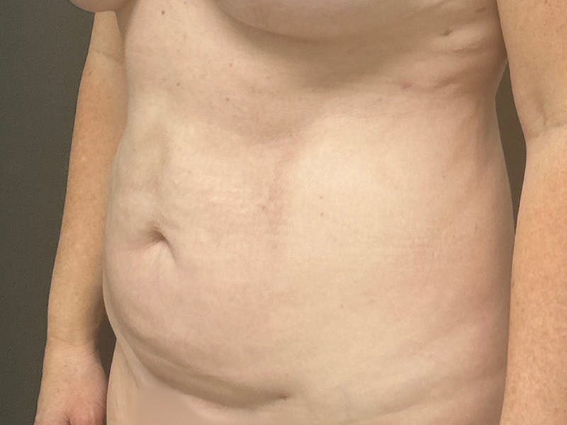 Abdomen Before & After Gallery - Patient 332408 - Image 8