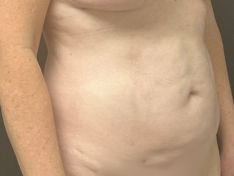 Abdomen Before & After Gallery - Patient 332408 - Image 4