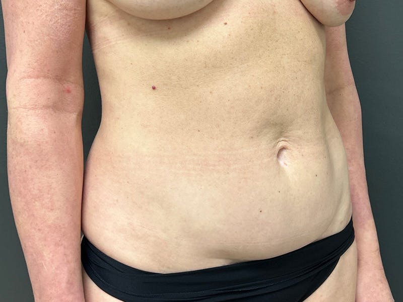 Abdomen Before & After Gallery - Patient 357328 - Image 3