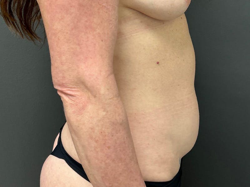 Abdomen Before & After Gallery - Patient 357328 - Image 5