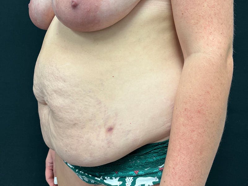 Tummy Tuck Before & After Gallery - Patient 187996 - Image 7