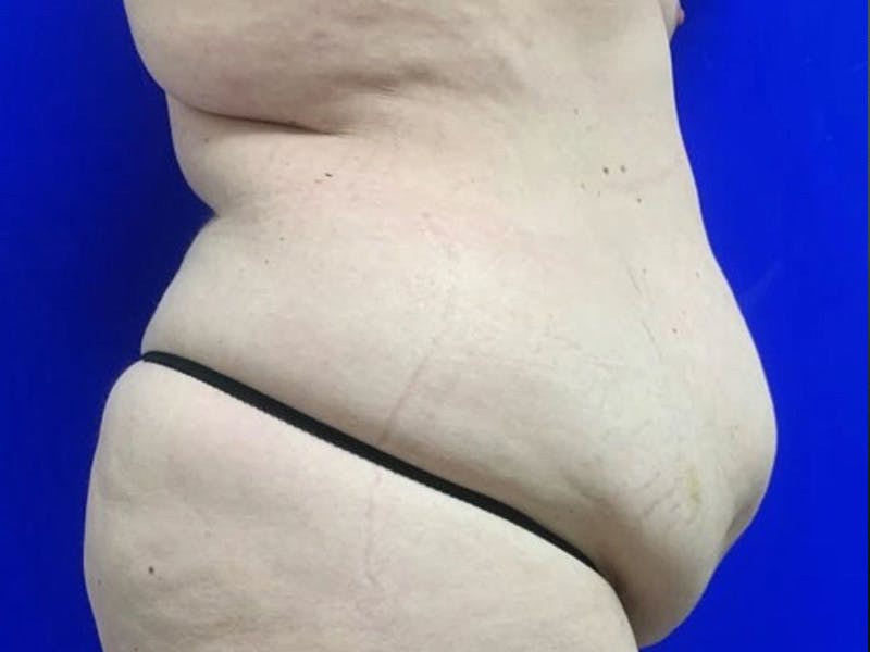 Tummy Tuck Before & After Gallery - Patient 404858 - Image 5