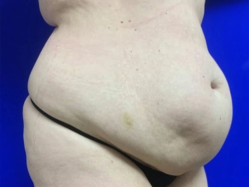 Tummy Tuck Before & After Gallery - Patient 404858 - Image 3