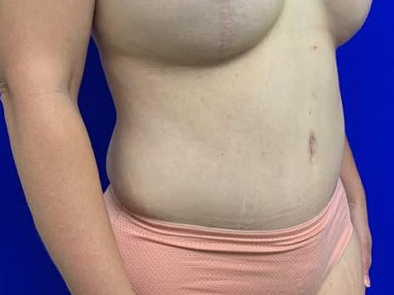 Tummy Tuck Before & After Gallery - Patient 308747 - Image 4