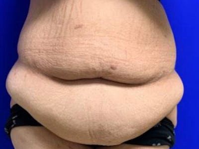 Tummy Tuck Before & After Gallery - Patient 374126 - Image 1