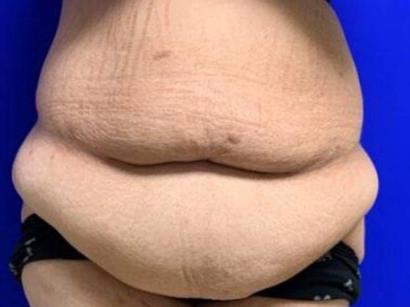 Tummy Tuck Before & After Gallery - Patient 374126 - Image 1