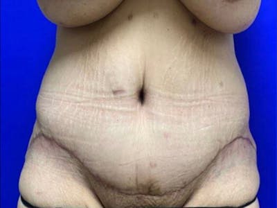 Tummy Tuck Before & After Gallery - Patient 374126 - Image 2