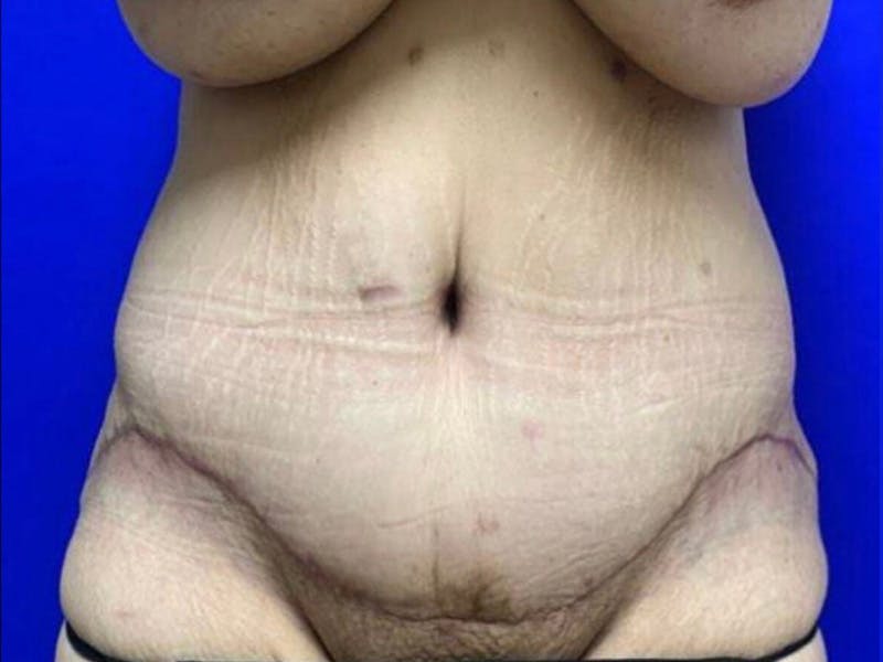 Tummy Tuck Before & After Gallery - Patient 374126 - Image 2