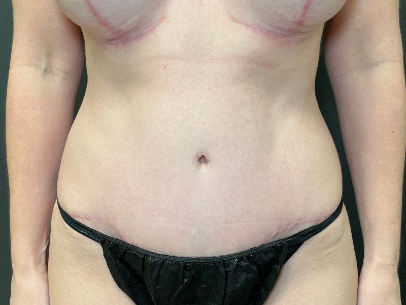 Tummy Tuck Before & After Gallery - Patient 223386 - Image 2