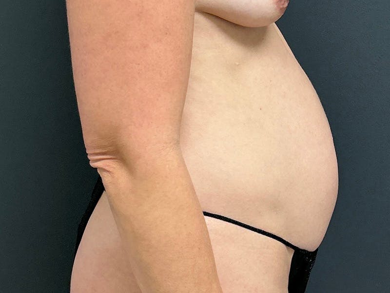 Tummy Tuck Before & After Gallery - Patient 289695 - Image 5