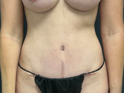 Tummy Tuck Before & After Gallery - Patient 289695 - Image 2