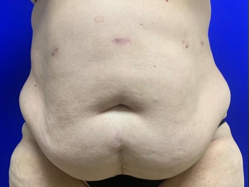 Tummy Tuck Before & After Gallery - Patient 548883 - Image 1