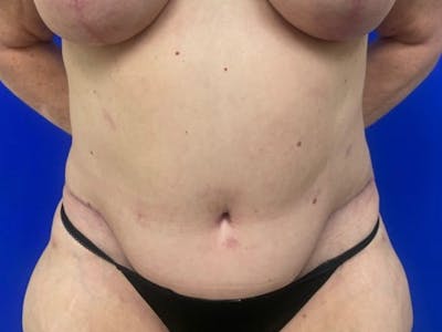 Tummy Tuck Before & After Gallery - Patient 548883 - Image 2