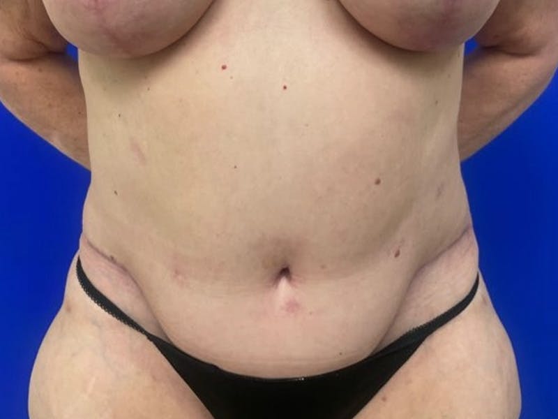 Tummy Tuck Before & After Gallery - Patient 548883 - Image 2