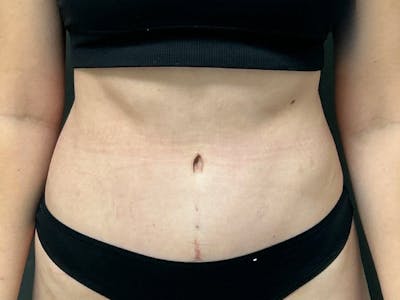 Tummy Tuck Before & After Gallery - Patient 266737 - Image 1