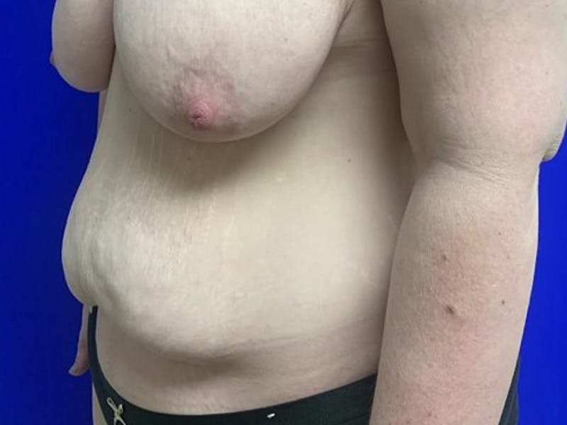 Tummy Tuck Before & After Gallery - Patient 115727 - Image 3