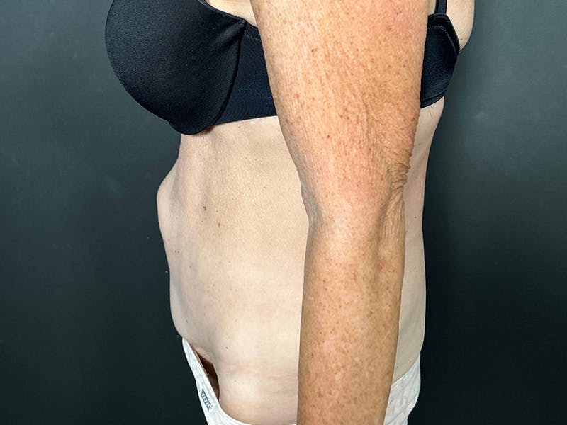 Tummy Tuck Before & After Gallery - Patient 394420 - Image 9