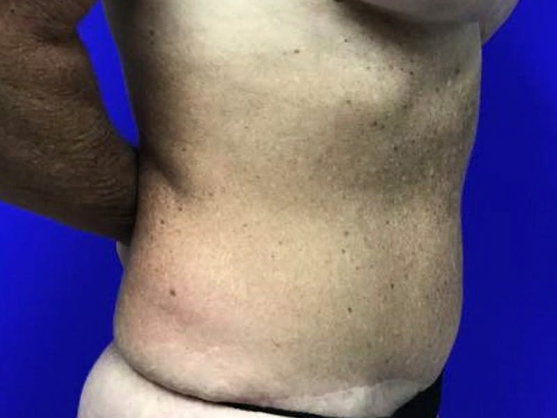 Tummy Tuck Before & After Gallery - Patient 334681 - Image 4