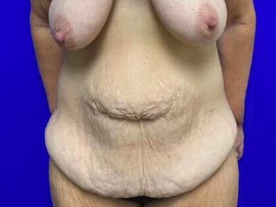 Tummy Tuck Before & After Gallery - Patient 165824 - Image 1