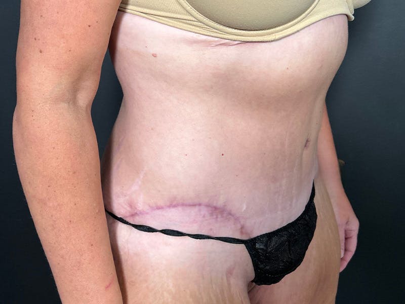 Tummy Tuck Before & After Gallery - Patient 165824 - Image 4