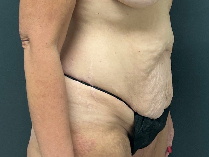 Tummy Tuck Before & After Gallery - Patient 215602 - Image 3