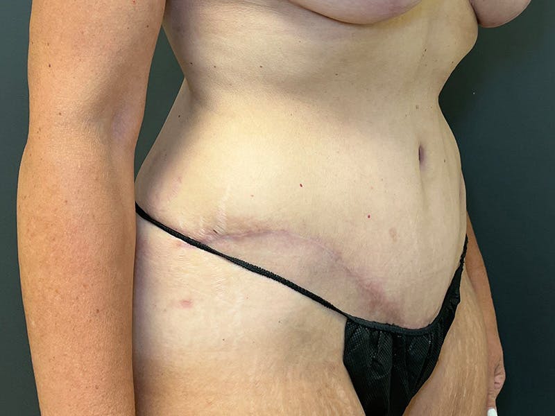 Tummy Tuck Before & After Gallery - Patient 215602 - Image 4