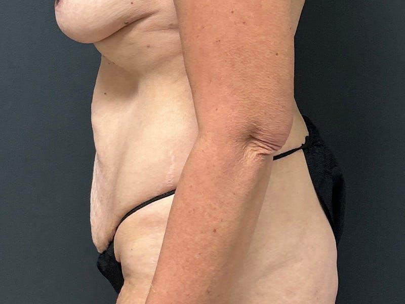 Tummy Tuck Before & After Gallery - Patient 215602 - Image 9