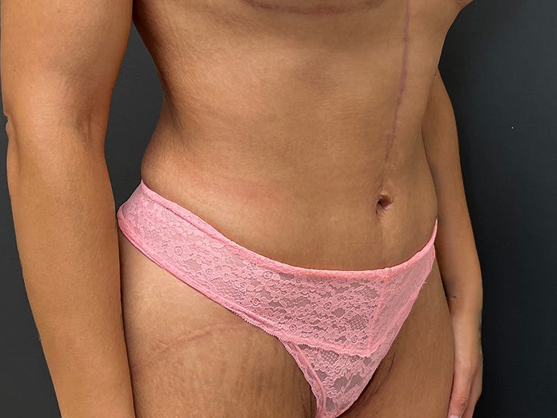 Tummy Tuck Before & After Gallery - Patient 102921 - Image 4