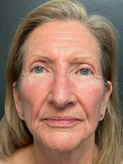 Facelift Before & After Gallery - Patient 855873 - Image 1
