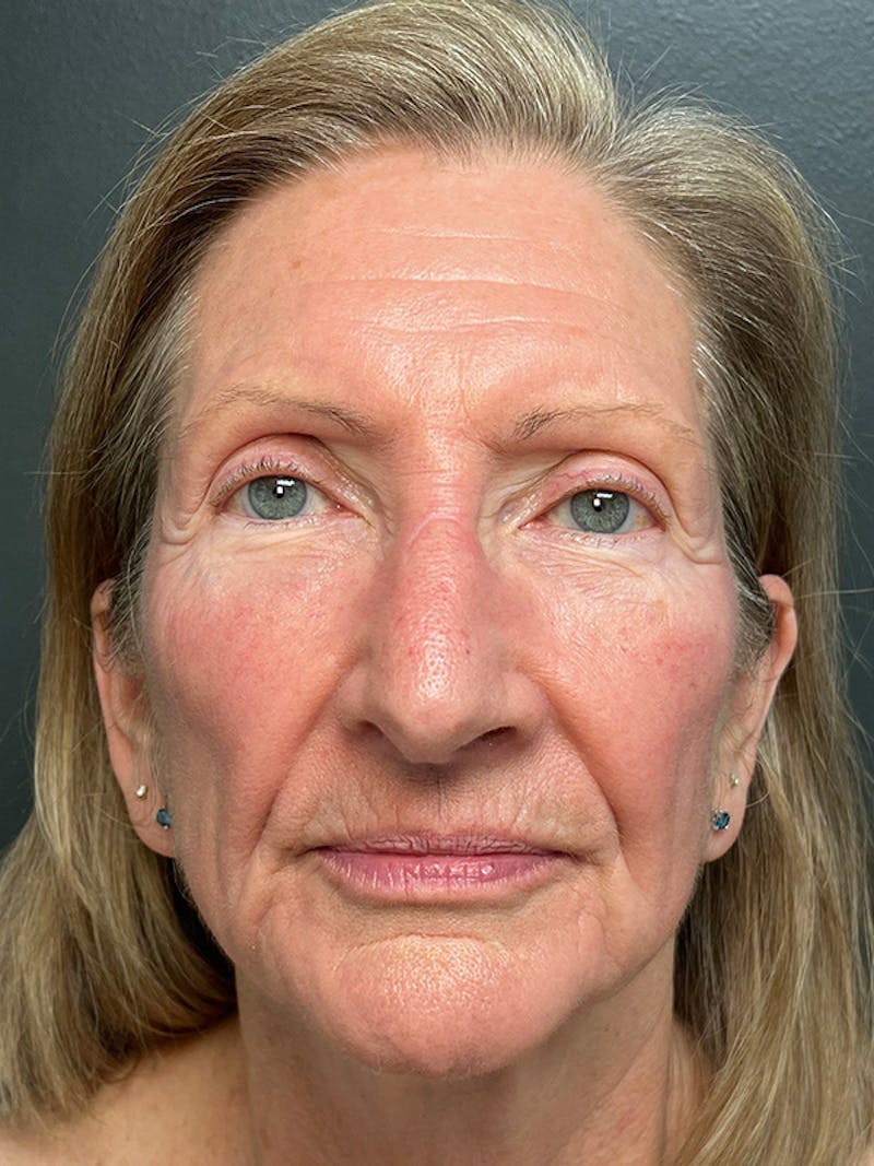 Earlobe Repair Before & After Gallery - Patient 298992 - Image 5