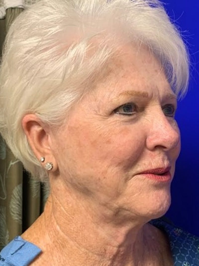 Facelift Before & After Gallery - Patient 775023 - Image 3