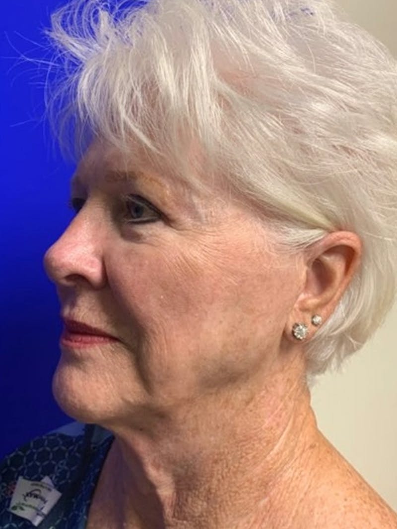 Facelift Before & After Gallery - Patient 775023 - Image 5
