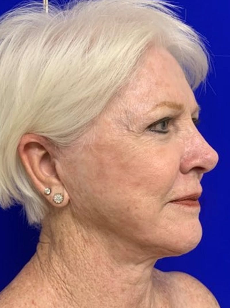 Facelift Before & After Gallery - Patient 775023 - Image 4
