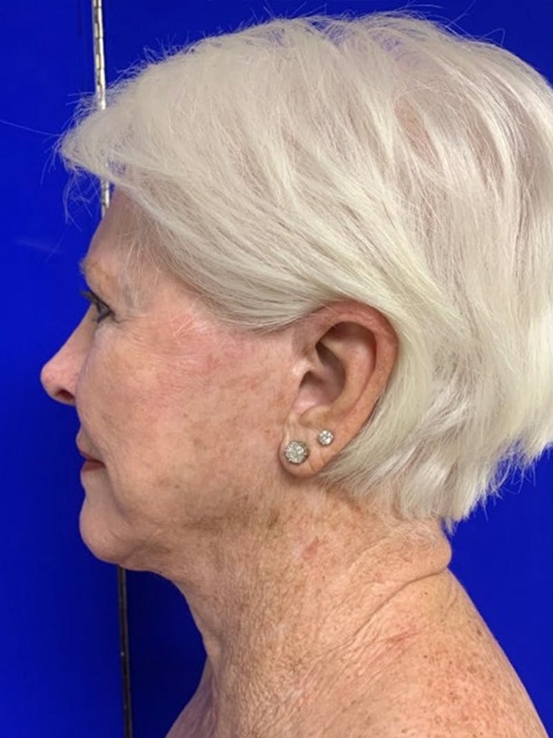 Facelift Before & After Gallery - Patient 775023 - Image 8