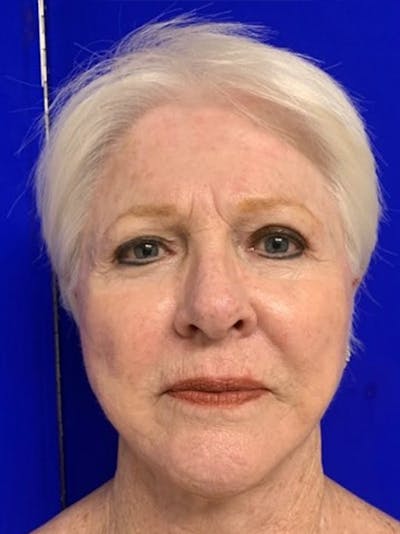 Facelift Before & After Gallery - Patient 775023 - Image 2