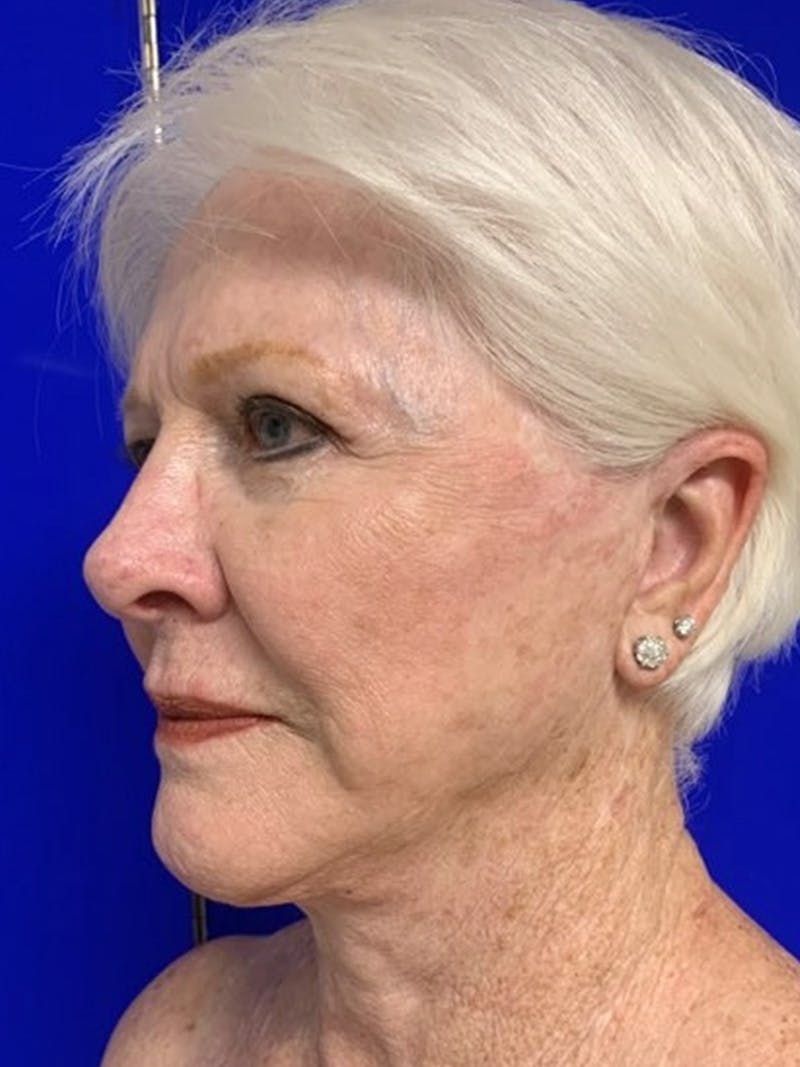 Facelift Before & After Gallery - Patient 775023 - Image 6