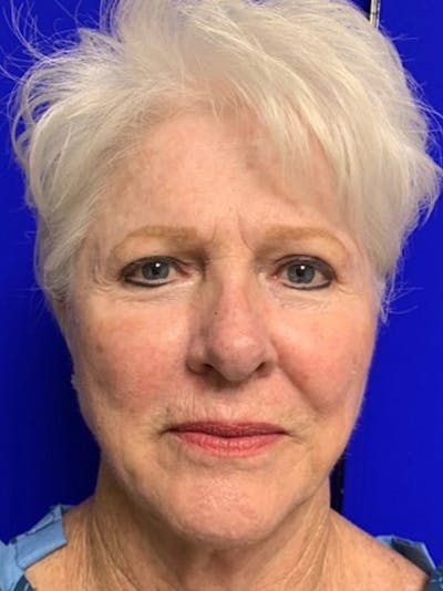 Facelift Before & After Gallery - Patient 775023 - Image 1