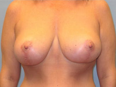 Mastopexy (Breast Lift) Before & After Gallery - Patient 390535 - Image 2
