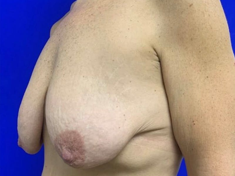 Mastopexy (Breast Lift) Before & After Gallery - Patient 391662 - Image 3