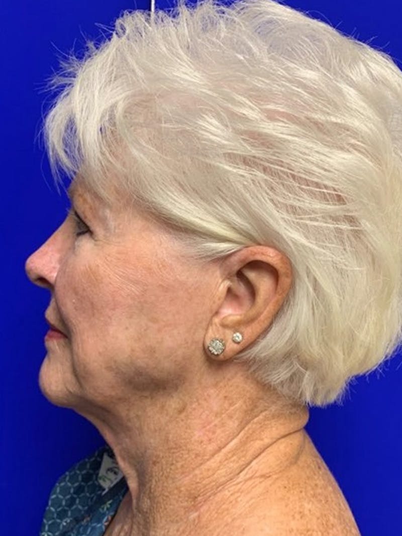 Facelift Before & After Gallery - Patient 775023 - Image 7