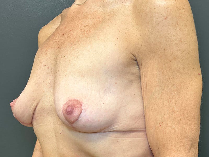 Mastopexy (Breast Lift) Before & After Gallery - Patient 391662 - Image 4