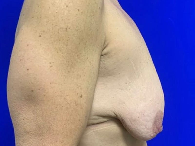 Mastopexy (Breast Lift) Before & After Gallery - Patient 391662 - Image 5