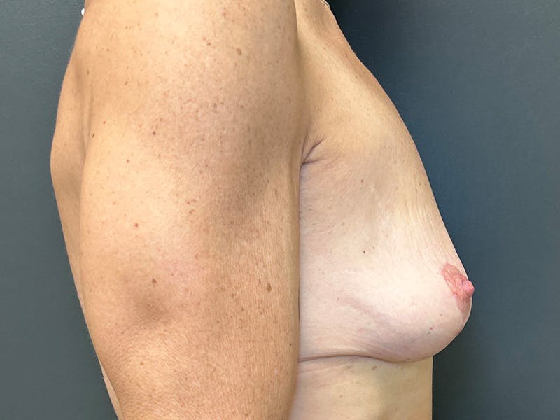 Mastopexy (Breast Lift) Before & After Gallery - Patient 391662 - Image 6