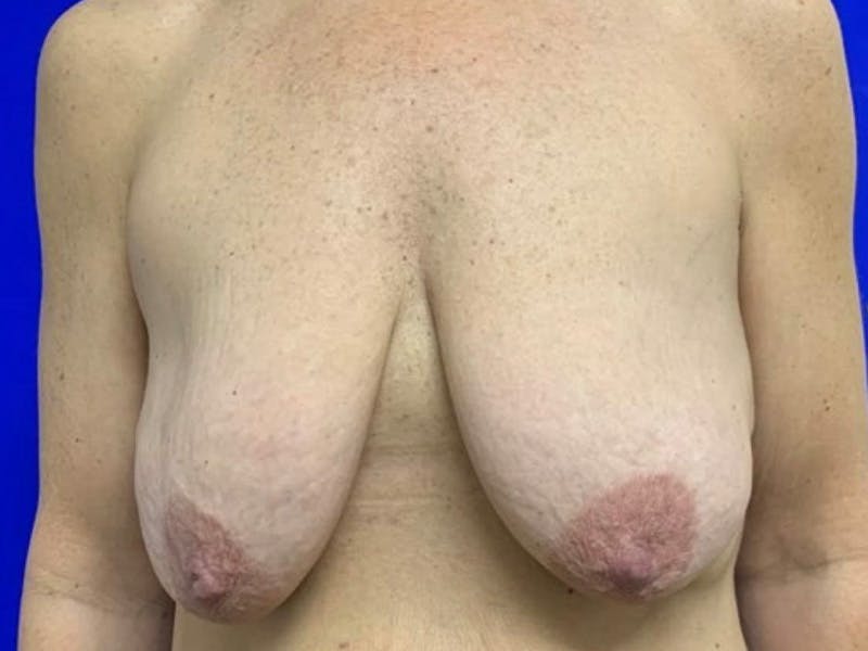 Mastopexy (Breast Lift) Before & After Gallery - Patient 391662 - Image 1