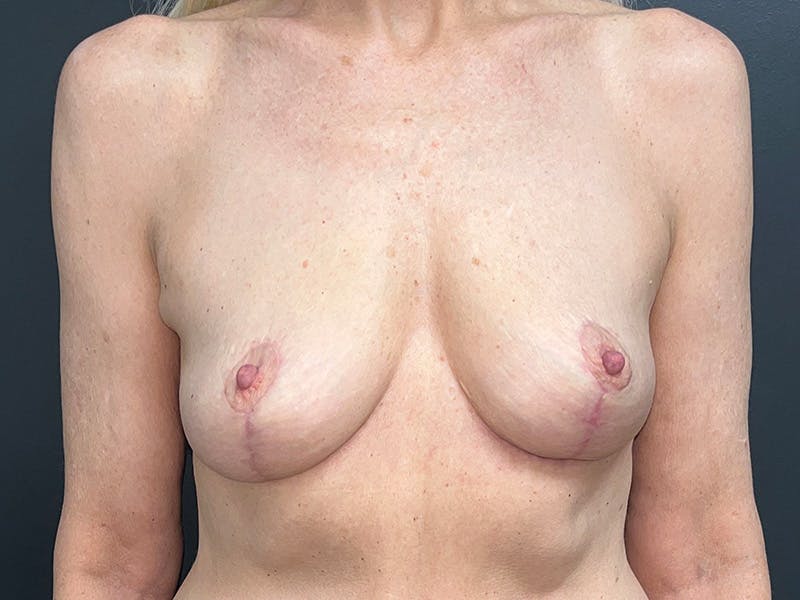 Mastopexy (Breast Lift) Before & After Gallery - Patient 421436 - Image 2