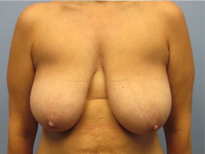 Mastopexy (Breast Lift) Before & After Gallery - Patient 390535 - Image 1